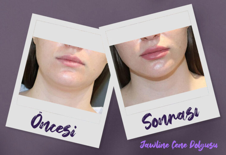 Jawline Çene Dolgusu Dr. Kayhan Durgun