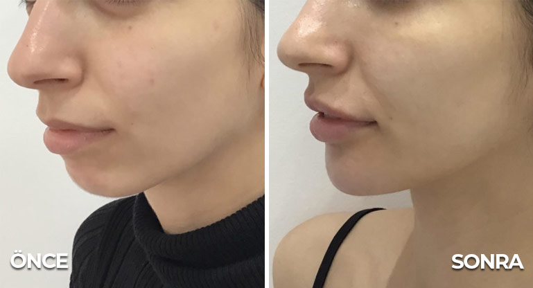 Jawline Çene Dolgusu öncesi ve sonrası resimleri